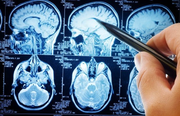 Kernel: Ein Chip im Gehirn soll unser Gedächtnis verbessern. (Foto: Shutterstock)