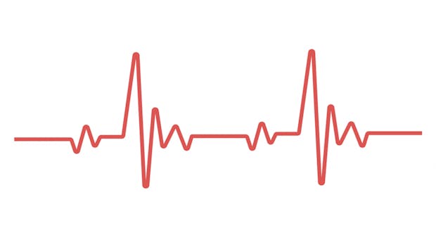 KI-Software RiskCardio ermittelt Herztod-Risiko aus einem einzigen EKG